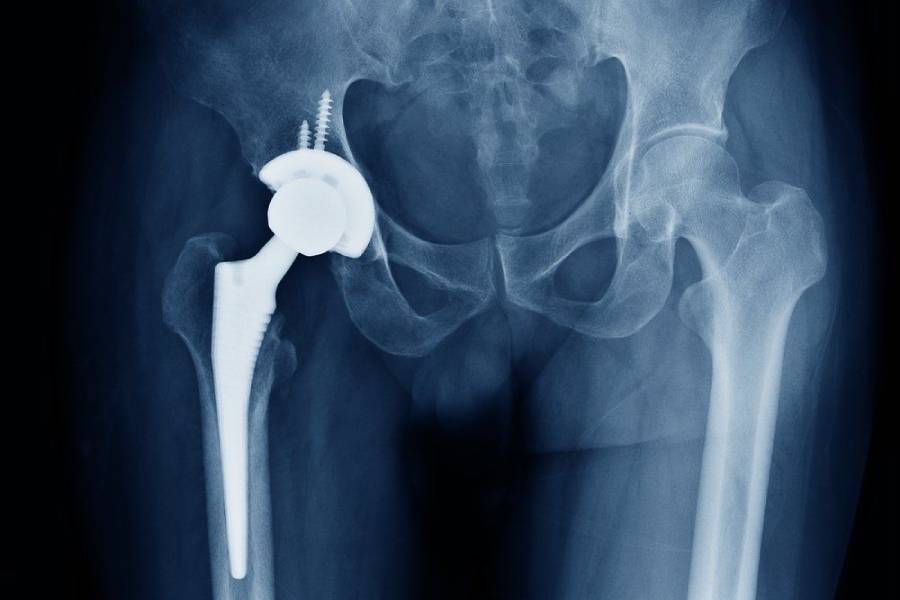 Best Hip replacement surgery in Ahmednagar - Dr. Prashant Kale