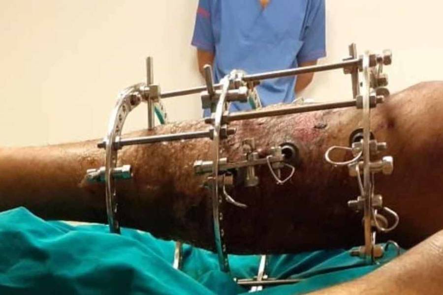 Ilizarov and limb reconstruction Surgery in Ahmednagar - Dr. Prashant Kale