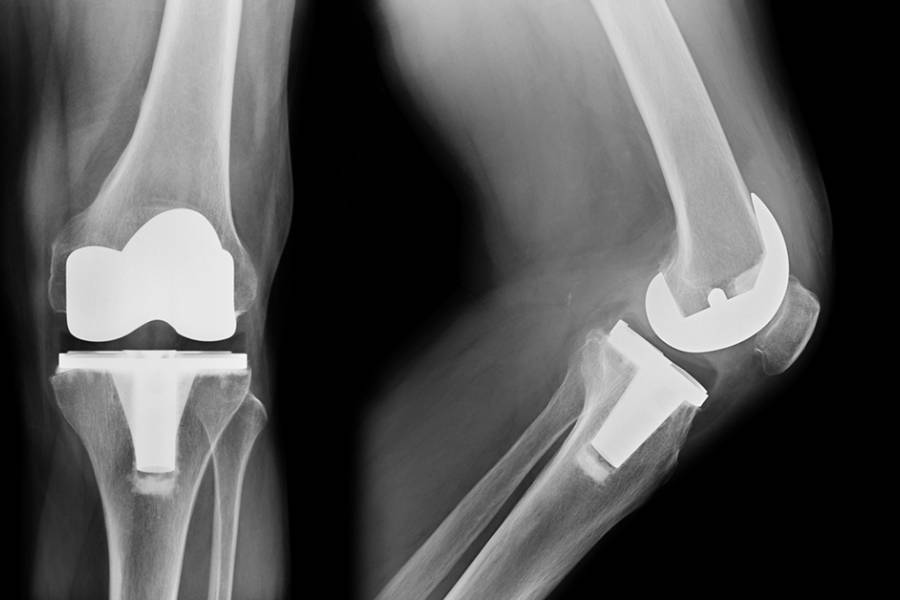 Revision Joint Replacement Surgery in Ahmednagar - Dr. Prashant Kale